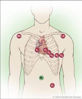 Ecg 10 Lead Placement Chart